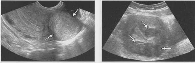 Эндометриоидная киста яичника и беременность
